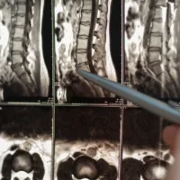Ocala Spinal Cord Injury Lawyer