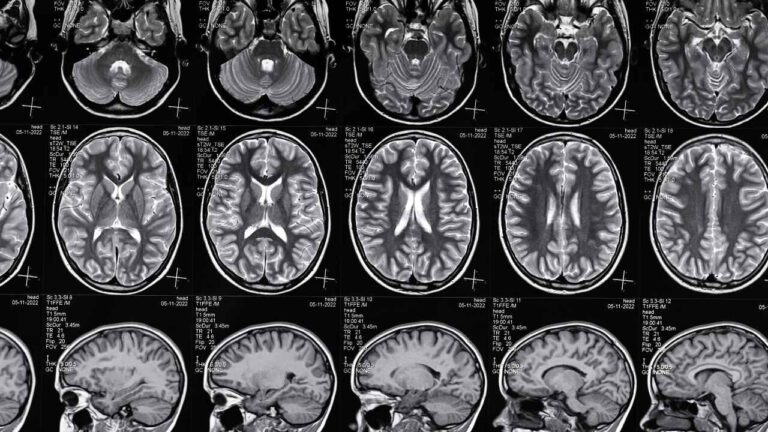 Traumatic Brain Injury Settlement Amounts in Florida