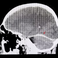 Gainesville Traumatic Brain Injury Attorney