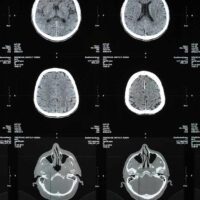 Aventura Traumatic Brain Injury Attorney