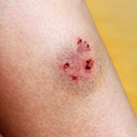 Hallandale Beach Dog Bite Attorney