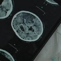 Williston Traumatic Brain Injury Lawyer