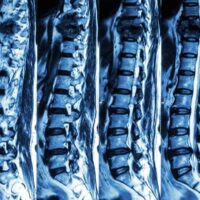 Hallandale Beach Spinal Cord Injury Attorney