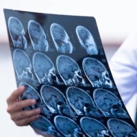 High Springs Traumatic Brain Injury Attorney