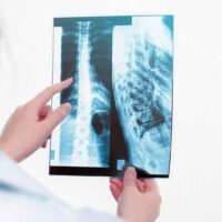 Miami Spinal Cord Injury Attorney Miami Spinal Cord Injury Attorney