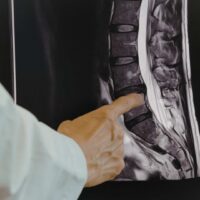 Newberry Spinal Cord Injury Attorney Newberry Spinal Cord Injury Attorney