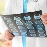 Belleview Traumatic Brain Injury Attorney Belleview Traumatic Brain Injury Attorney