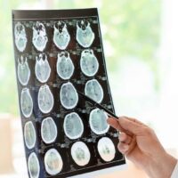 Summerfield Traumatic Brain Injury Attorney Summerfield Traumatic Brain Injury Attorney